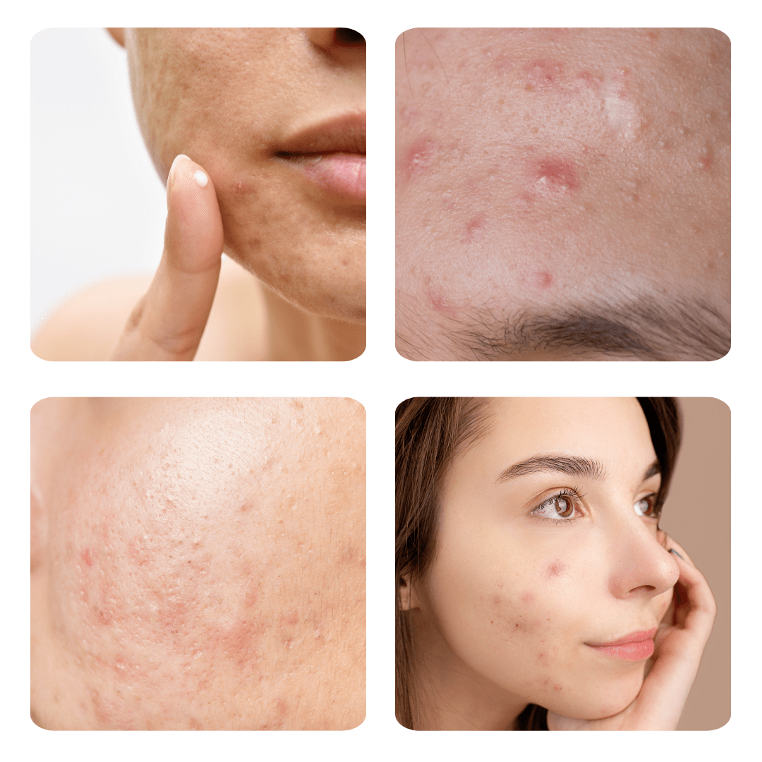 proffessional acne treatment in prague